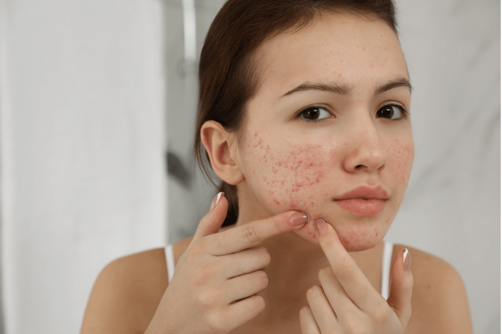 Understanding Acne: Causes, Types, and Treatment Options